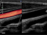 Ultraschallbild eines Gefässes