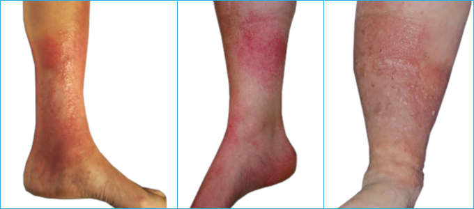 Stauungsdermatitis