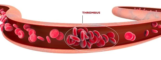 Thrombus in einem Gefäss