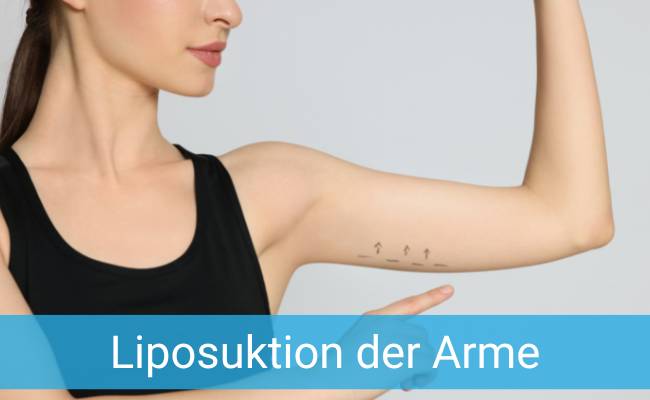 Liposuktion Arme